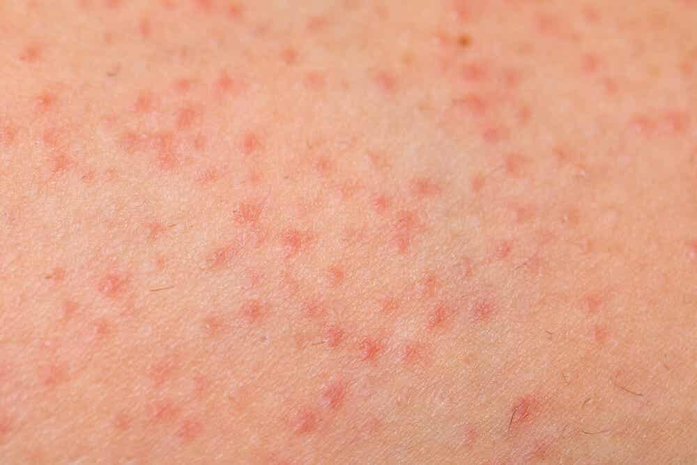 keratosis pilaris skin