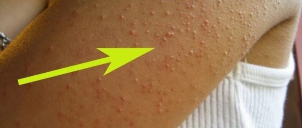 Keratosis pilaris