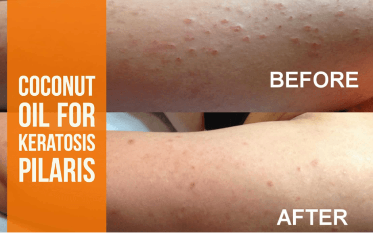 coconut oil keratosis pilaris before and after